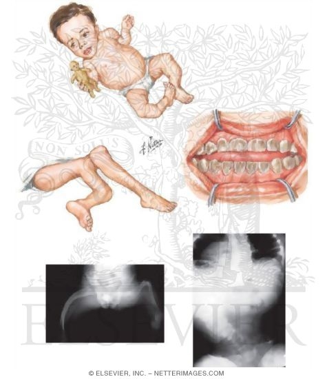Types III and IV Osteogenesis Imperfecta
