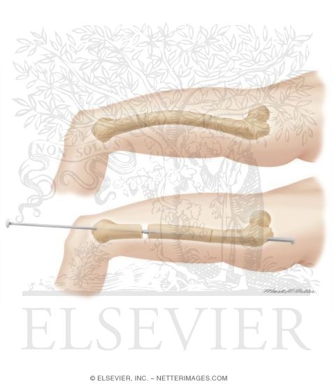 Watermarked preview of unlabeled image: Treatment of Osteogenesis Imperfecta By Intramedullary Fixation