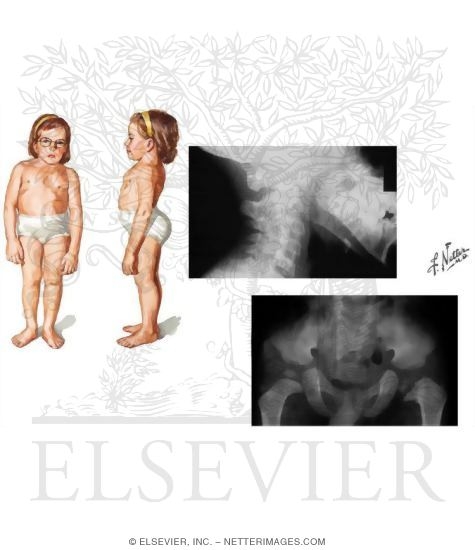 Watermarked preview of unlabeled image: Spondyloepiphyseal Dysplasia Congenita