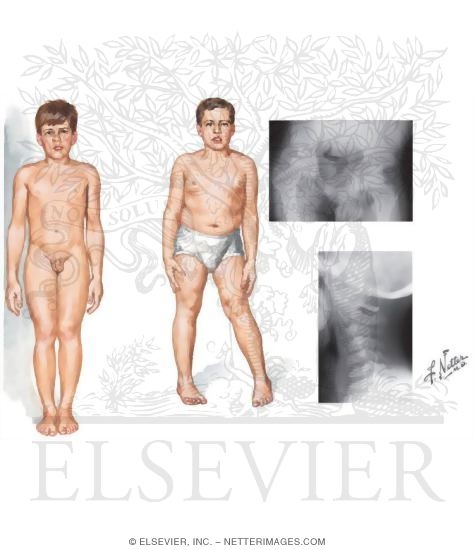 Spondyloepiphyseal Dysplasia Tarda
