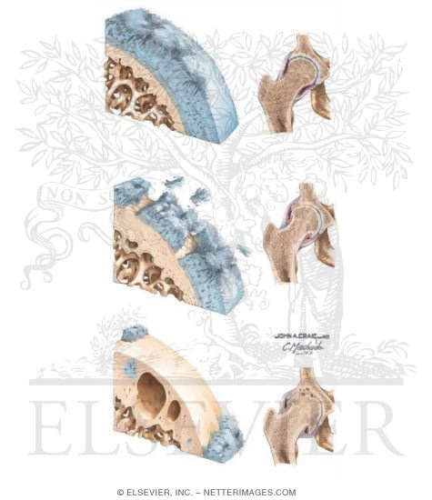Watermarked preview of unlabeled image: Histopathology of Osteoarthritis