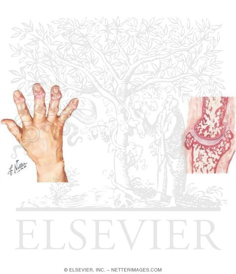 Watermarked preview of unlabeled image: Hand In Osteoarthritis (OA)