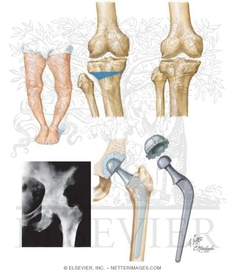 Watermarked preview of unlabeled image: Surgical Alternatives for Osteoarthritis (OA)