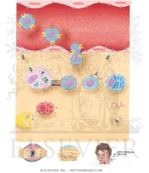 Watermarked preview of unlabeled image: Immunopathogenesis of Rheumatoid Arthritis