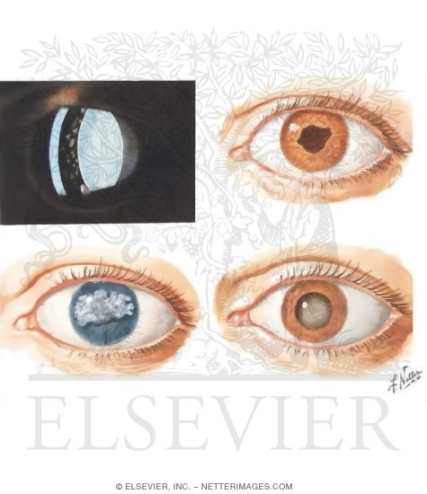 artritis+ocular