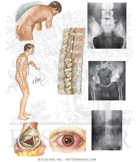 Watermarked preview of unlabeled image: Ankylosing Spondylitis