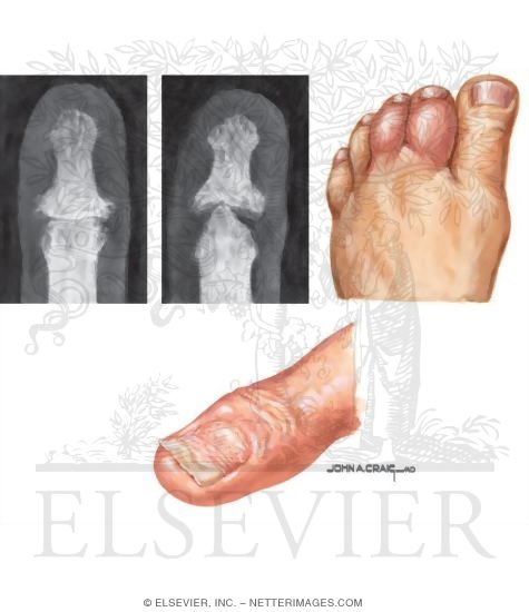 Watermarked preview of unlabeled image: Psoriatic Arthritis