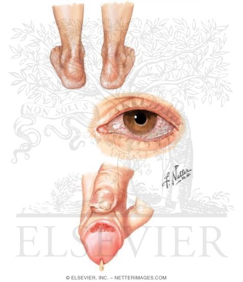 Reactive Arthritis