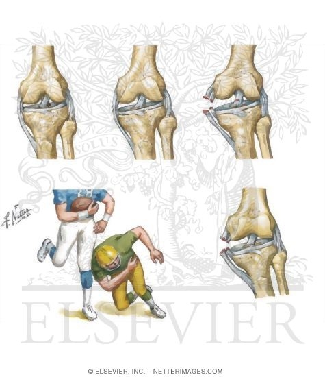 Grading of Ligament Sprains