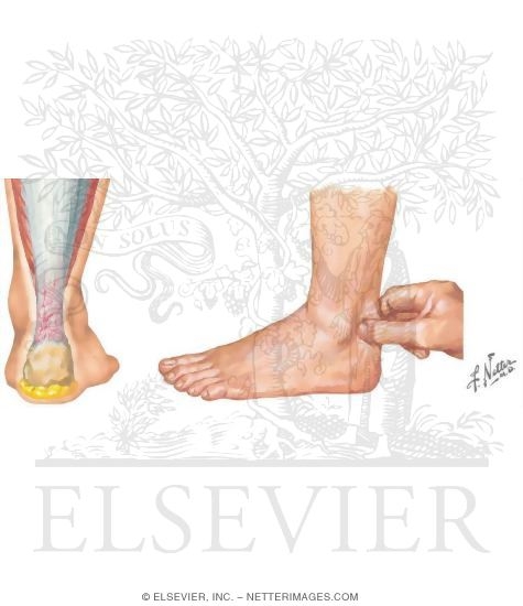 Watermarked preview of unlabeled image: Achilles Insertional Tendinopathy