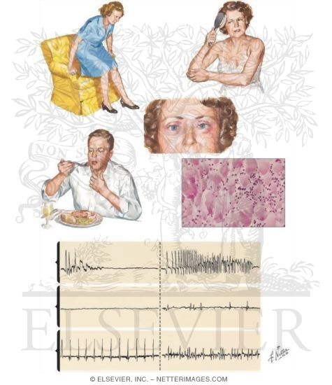 Watermarked preview of unlabeled image: Polymyositis and Dermatomyositis