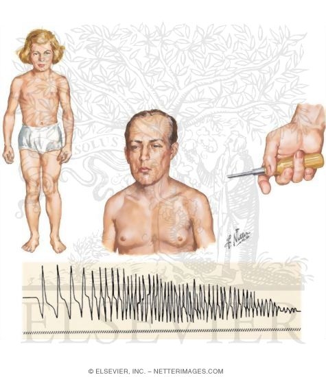 Watermarked preview of unlabeled image: Myotonia Congenita and Myotonic Dystrophies
