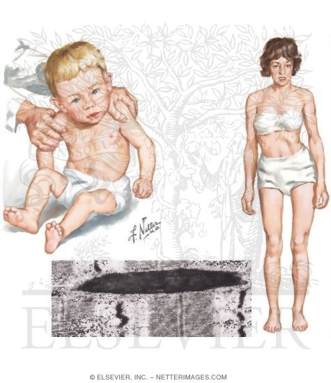 Nemaline Myopathy