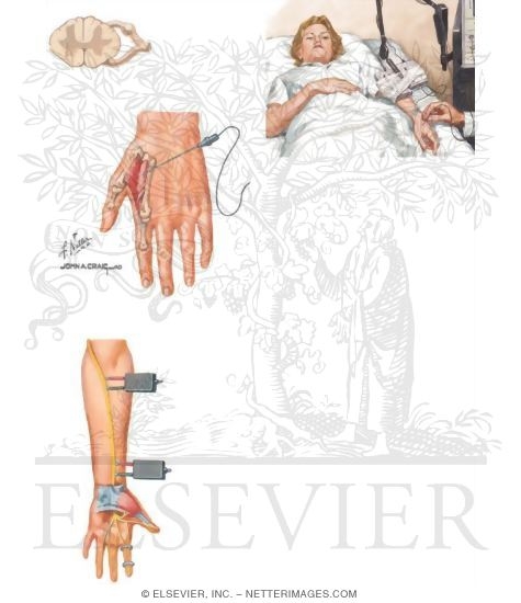 Electrodiagnostic Studies of Nerves
