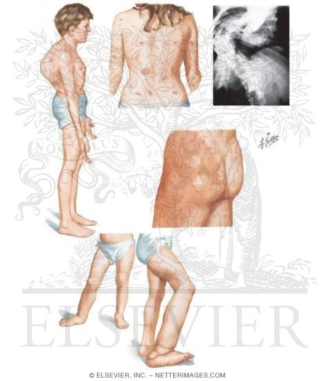 Watermarked preview of unlabeled image: Neurofibromatosis