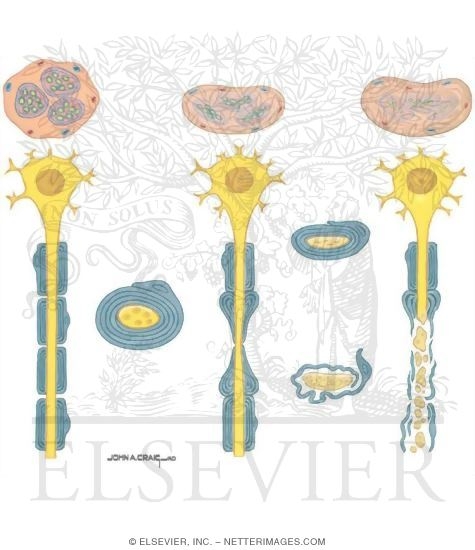 Watermarked preview of unlabeled image: Nerve Injury In Compression Neuropathy