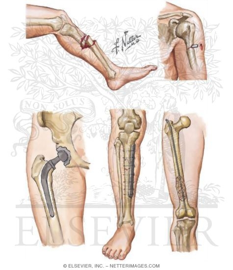 Watermarked preview of unlabeled image: Direct Causes of Osteomyelitis