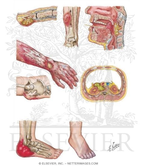Watermarked preview of unlabeled image: Direct Causes of Osteomyelitis