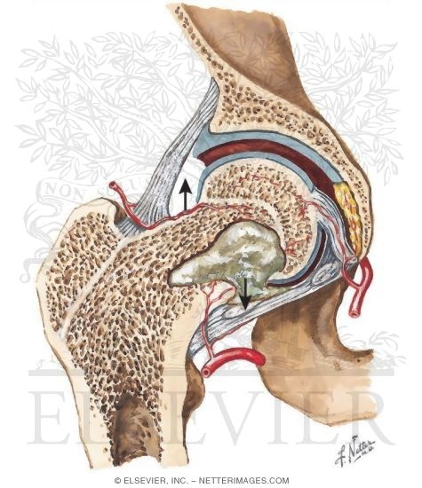 Watermarked preview of unlabeled image: Septic Arthritis Secondary to Concomitant Osteomyelitis
