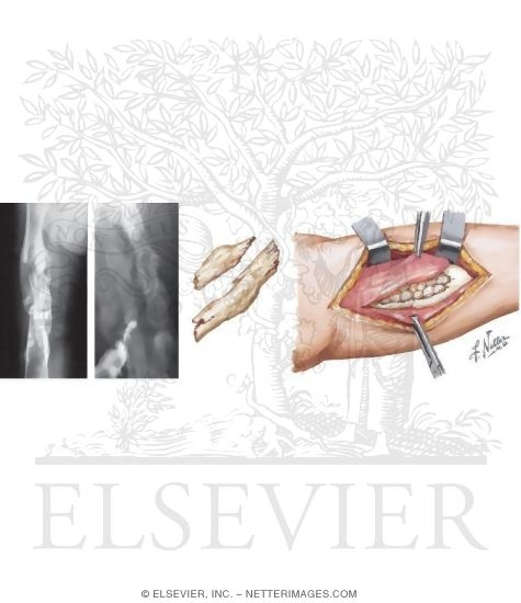 Watermarked preview of unlabeled image: Chronic Osteomyelitis