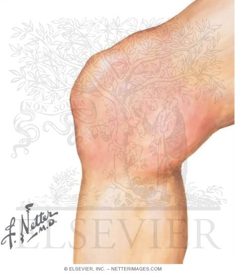 Watermarked preview of unlabeled image: Knee Joint Swollen and Held In a Flexed Position