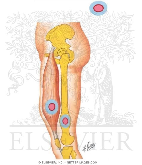 Watermarked preview of unlabeled image: Surgical Margins for Musculoskeletal Tumors