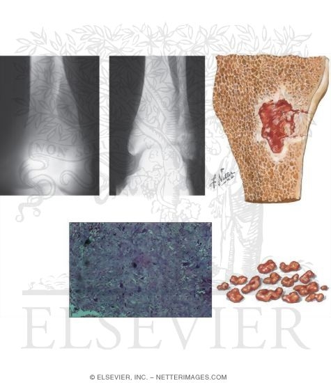 Nonossifying Fibroma