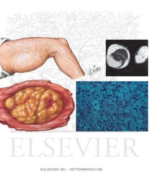 Watermarked preview of unlabeled image: Liposarcoma
