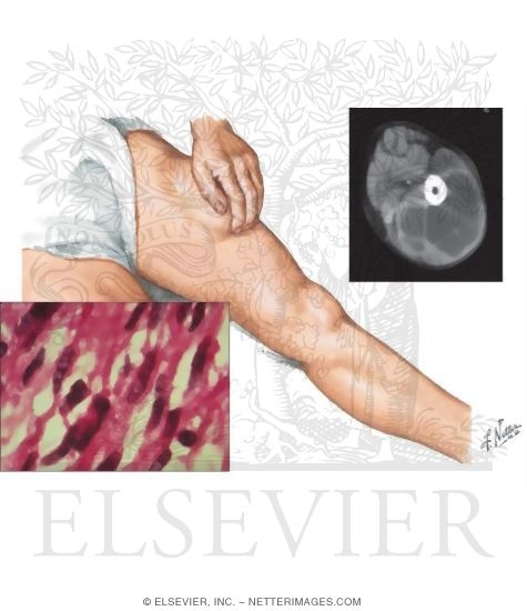 Watermarked preview of unlabeled image: Malignant Fibrous Histiocytoma of Soft Tissue