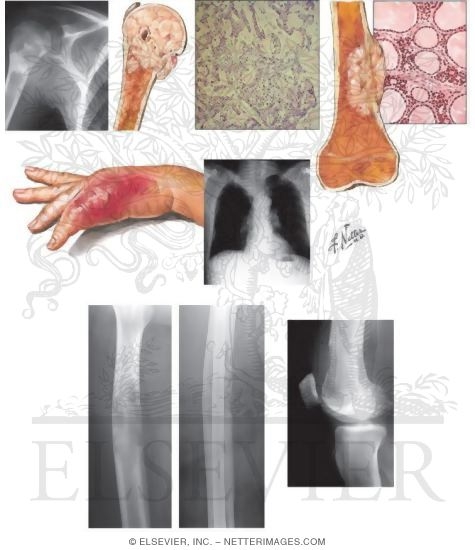 Watermarked preview of unlabeled image: Tumors Metastatic to Bone