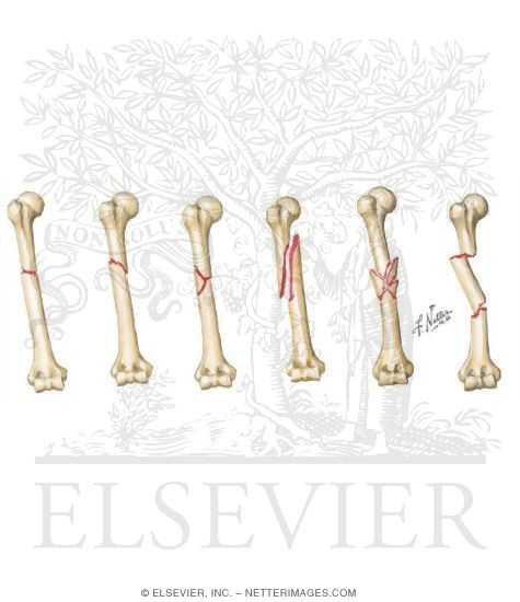 Watermarked preview of unlabeled image: Fracture Patterns