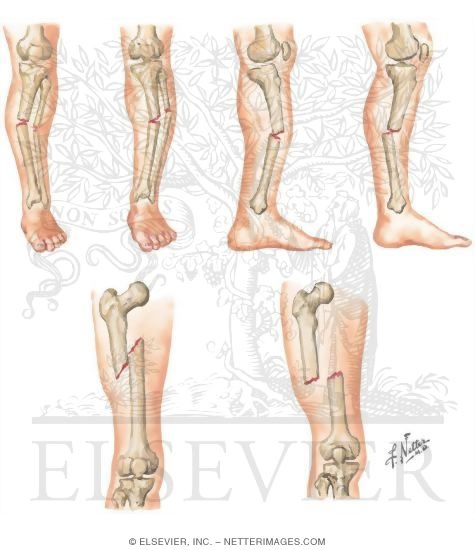 Watermarked preview of unlabeled image: Types of Displacement