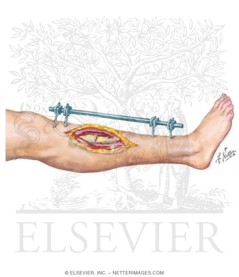 Watermarked preview of unlabeled image: External Fixation of Open Fracture
