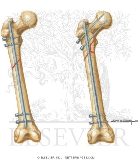 Intramedullary Rods for Broken Bones