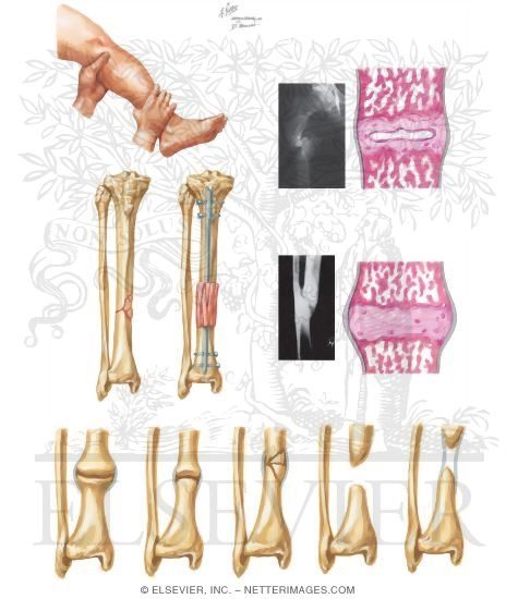 Watermarked preview of unlabeled image: Nonunion of Fracture