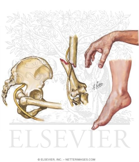 Watermarked preview of unlabeled image: Neurologic Complications of Fractures