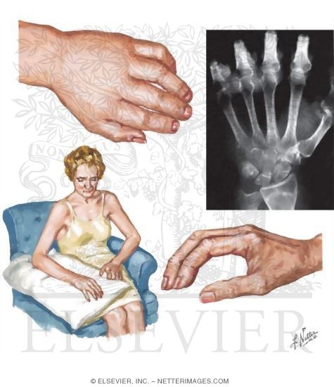 Reflex Sympathetic Dystrophy