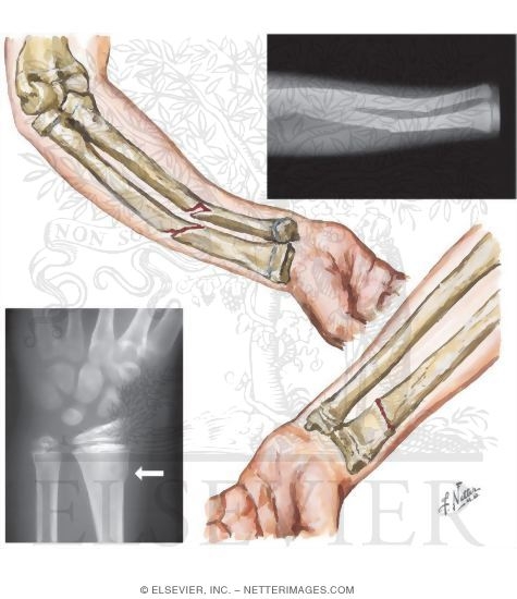 Greenstick and Torus Fractures In Children