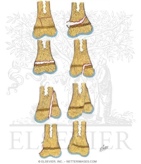Watermarked preview of unlabeled image: Peterson Classification of Physeal Fractures