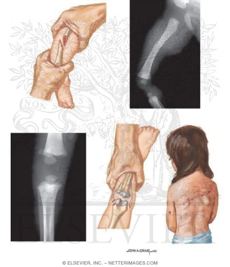 Watermarked preview of unlabeled image: Fracture In Abused Children