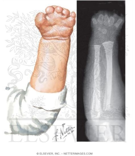 Congenital Transmetacarpal Amputation