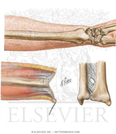Forearm Amputation