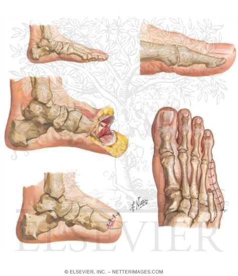 Watermarked preview of unlabeled image: Amputations of the Foot