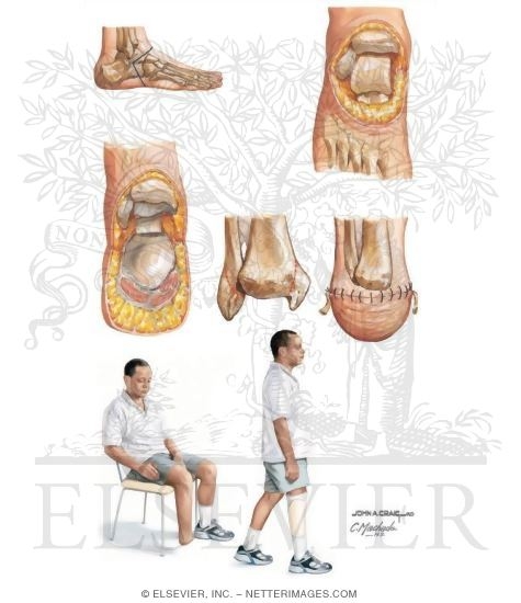 Ankle Disarticulation (Syme Amputation)