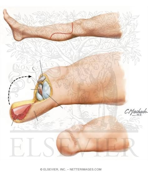 Transtibial Amputation