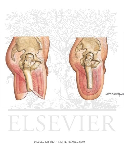 Transfemoral Amputation