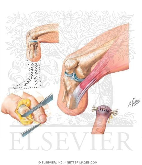 Complications of Amputations
