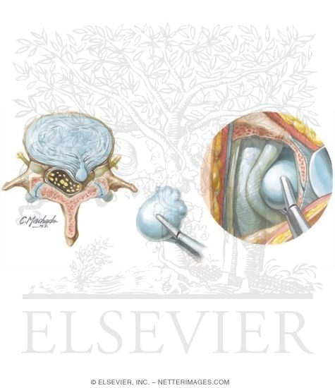 Watermarked preview of unlabeled image: Discectomy