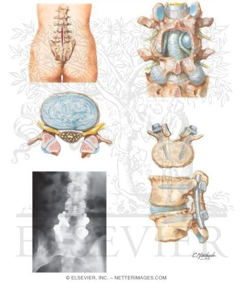 Watermarked preview of unlabeled image: Spinal Stenosis
