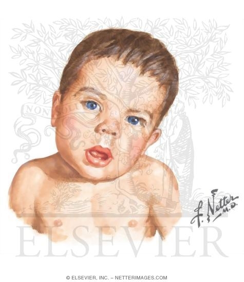 Watermarked preview of unlabeled image: Congenital Muscular Torticollis